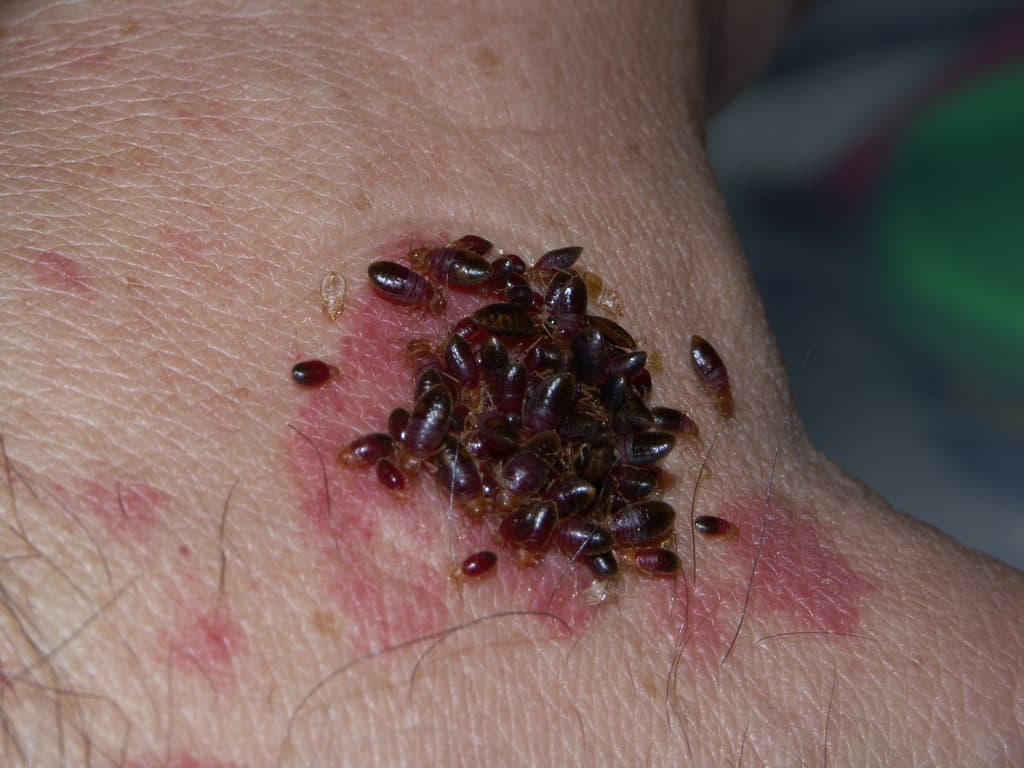 Bed Bug Bites