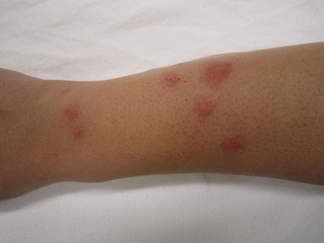 Causes Of Bed Bug Bite Scars