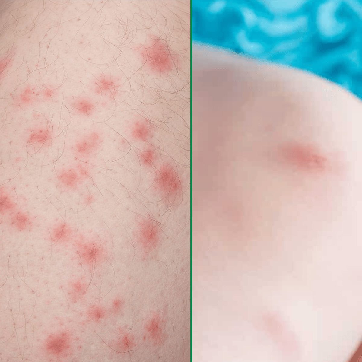 Comparison Of Bed Bug And Mosquito Bites