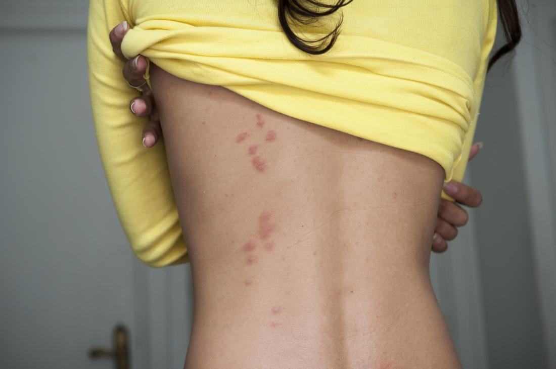 Home Remedies For Bed Bug Bite Scars