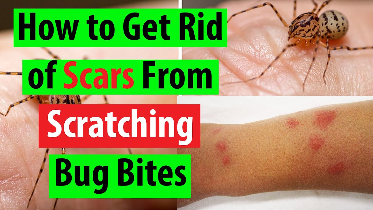 How to Get Rid of Bed Bug Bite Scars: Proven Tips from Bug Experts