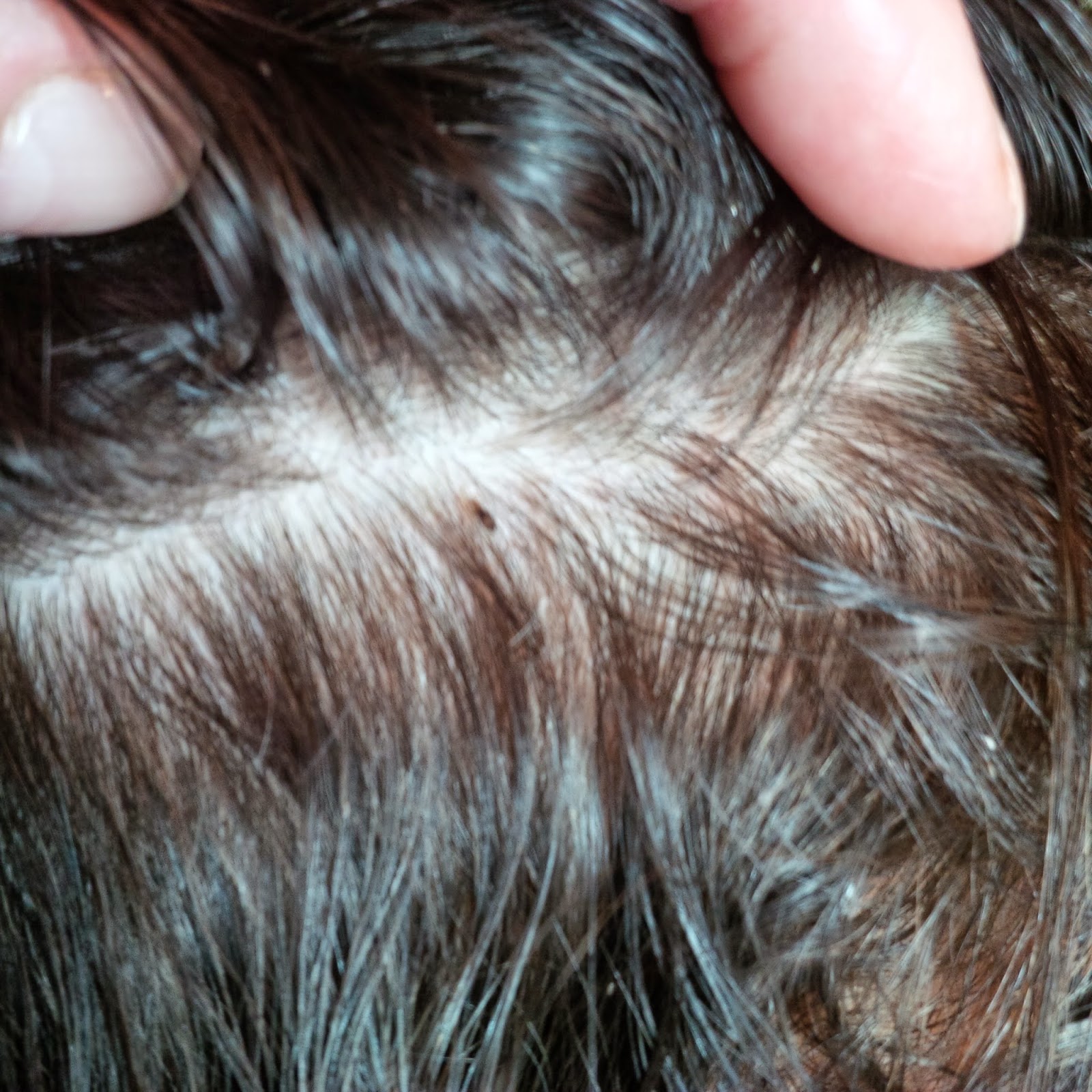 How To Identify Bed Bug Bites In Hair