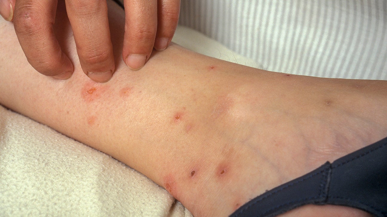 Medical Treatments For Bed Bug Bite Scars