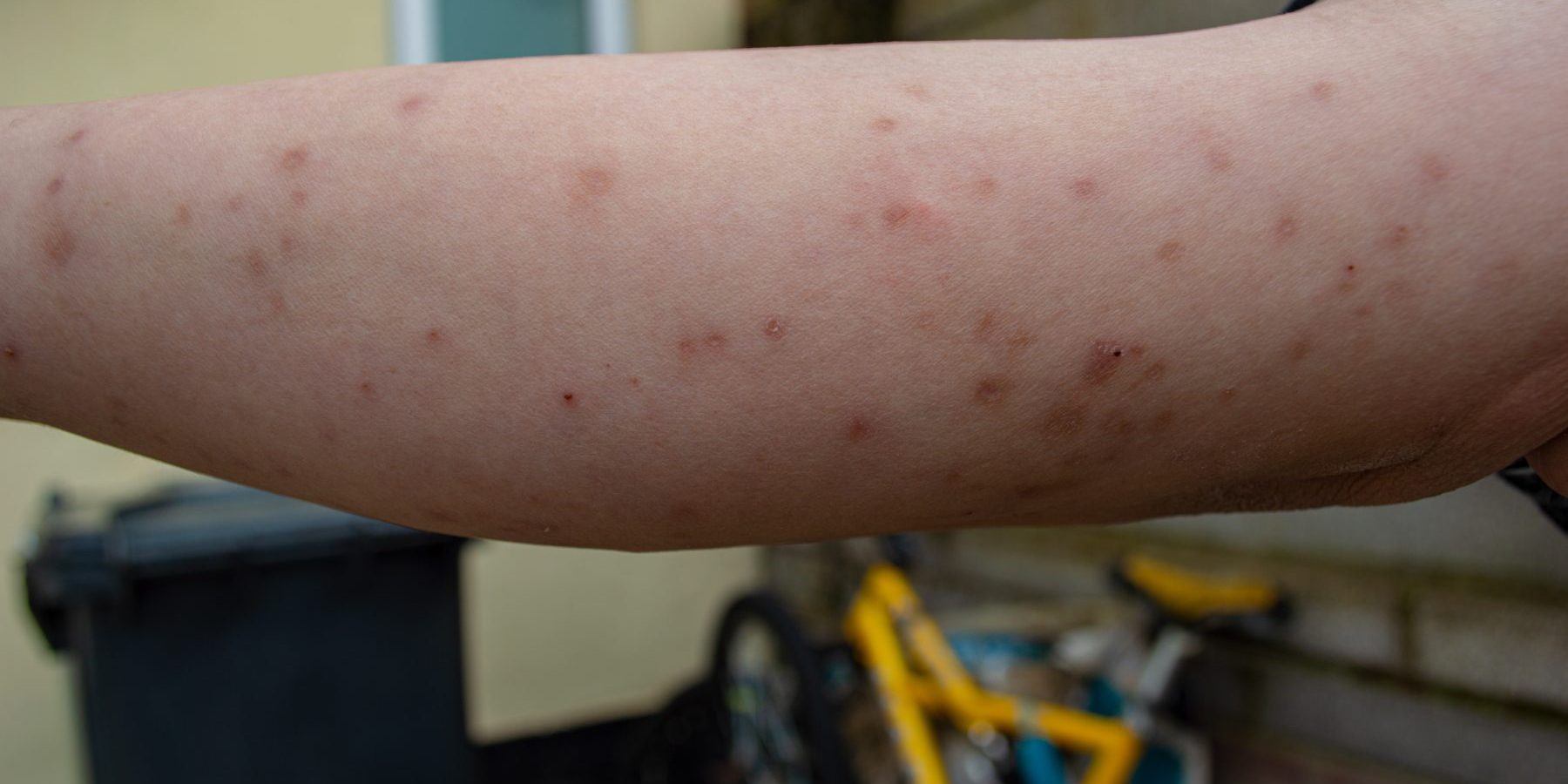 Over-The-Counter Products For Bed Bug Bite Scars