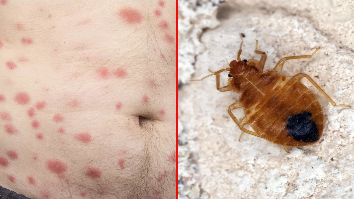 Signs Of Bed Bug Feeding
