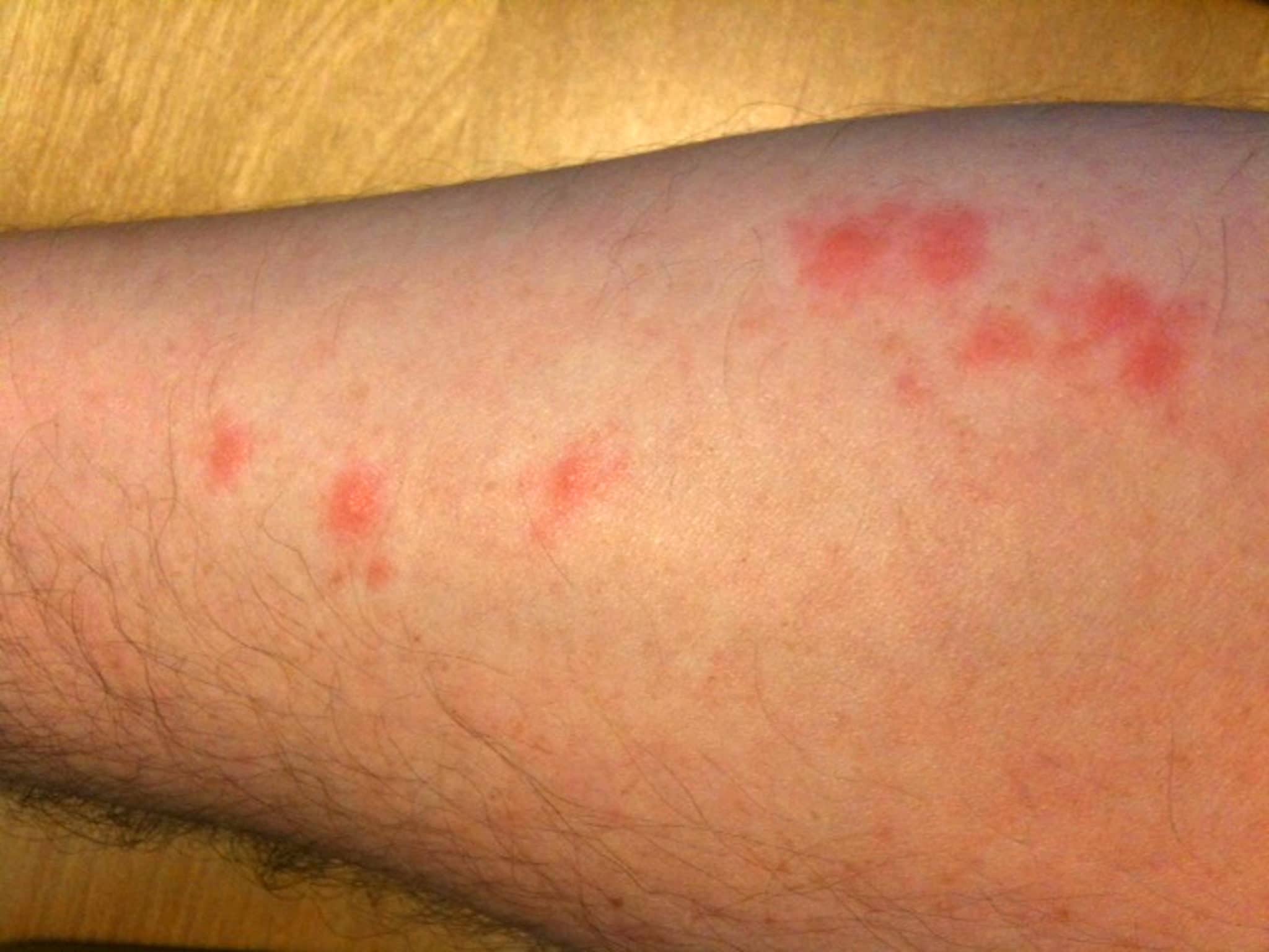 Signs Of Bed Bugs In A Car