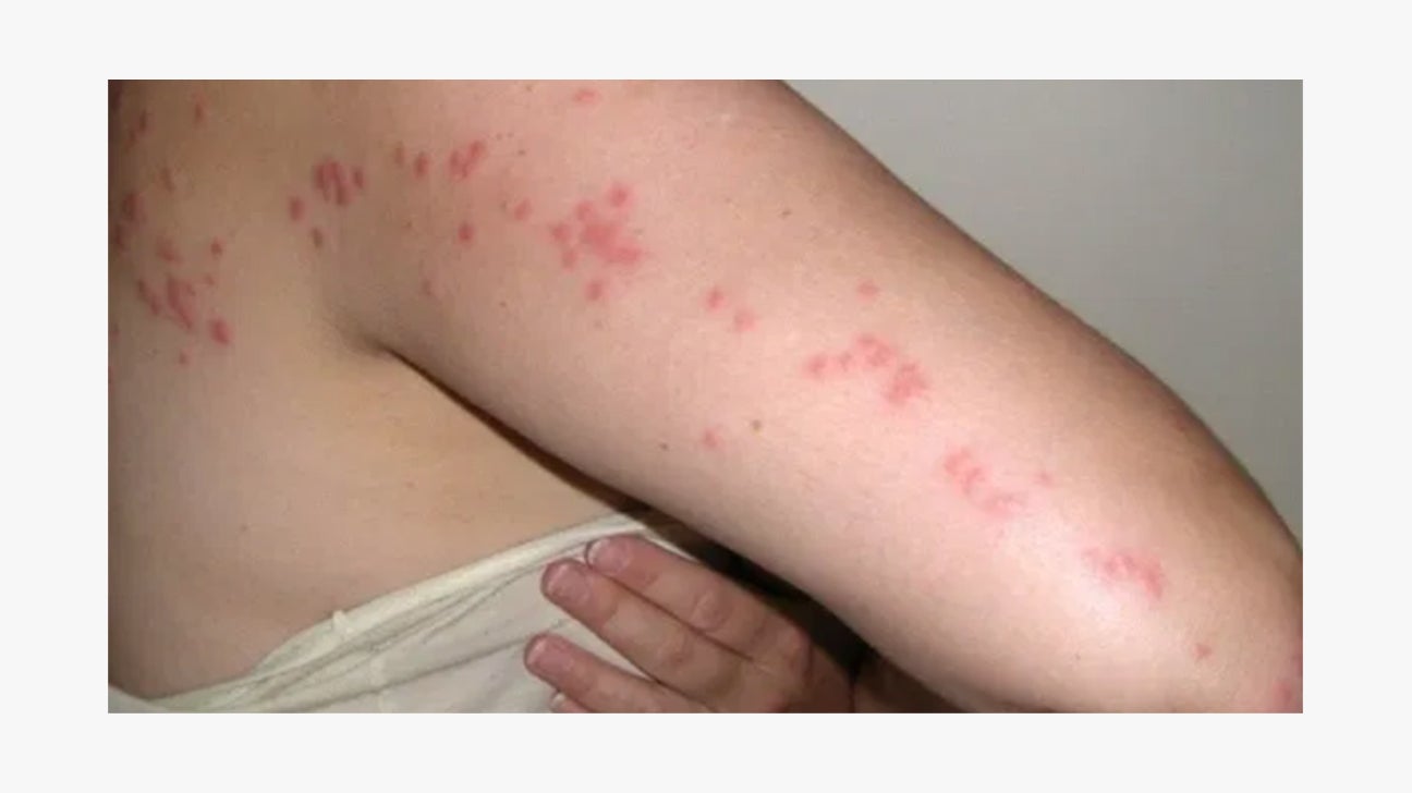 What Do Baby Bed Bug Bites Look Like?